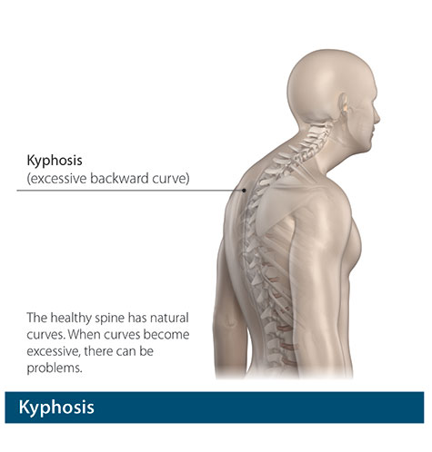 kyphosis panama, kyphosis panama, kyphosis treatment panama, spine surgeon panama, spine surgeon panama
